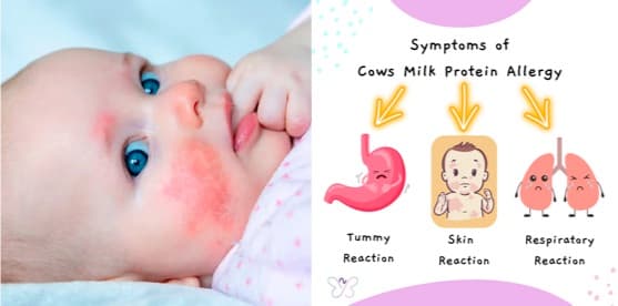 Dairy Consumption  Status in Adolescents with a History of Cow's Milk Allergy