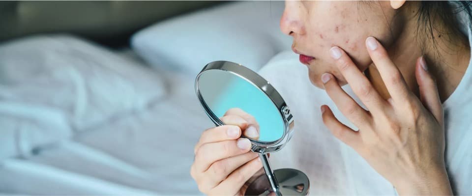 Does dairy cause acne or is it another skincare myth?